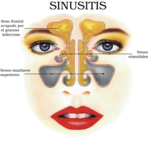 sinusitis
